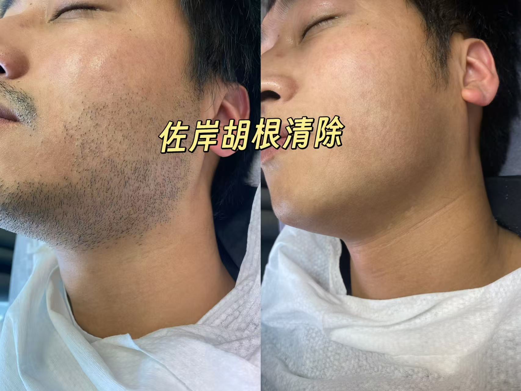 宁波脱胡子